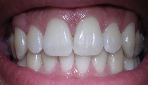 białe zęby2